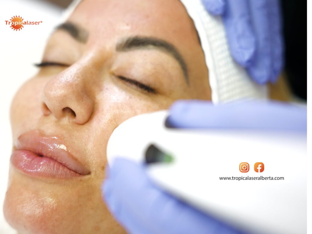 Edmonton Microneedling