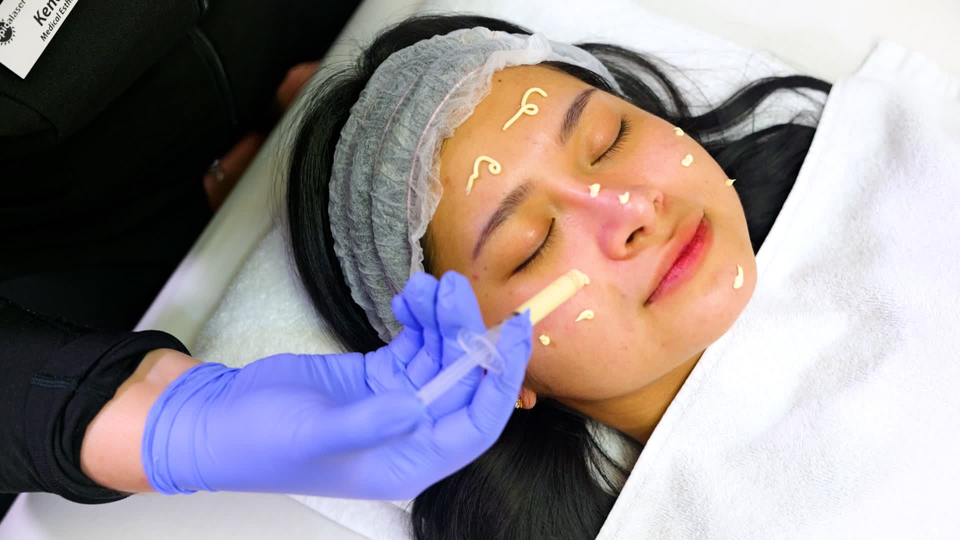 Chemical Peel Treatment Edmonton by Tropicalaser