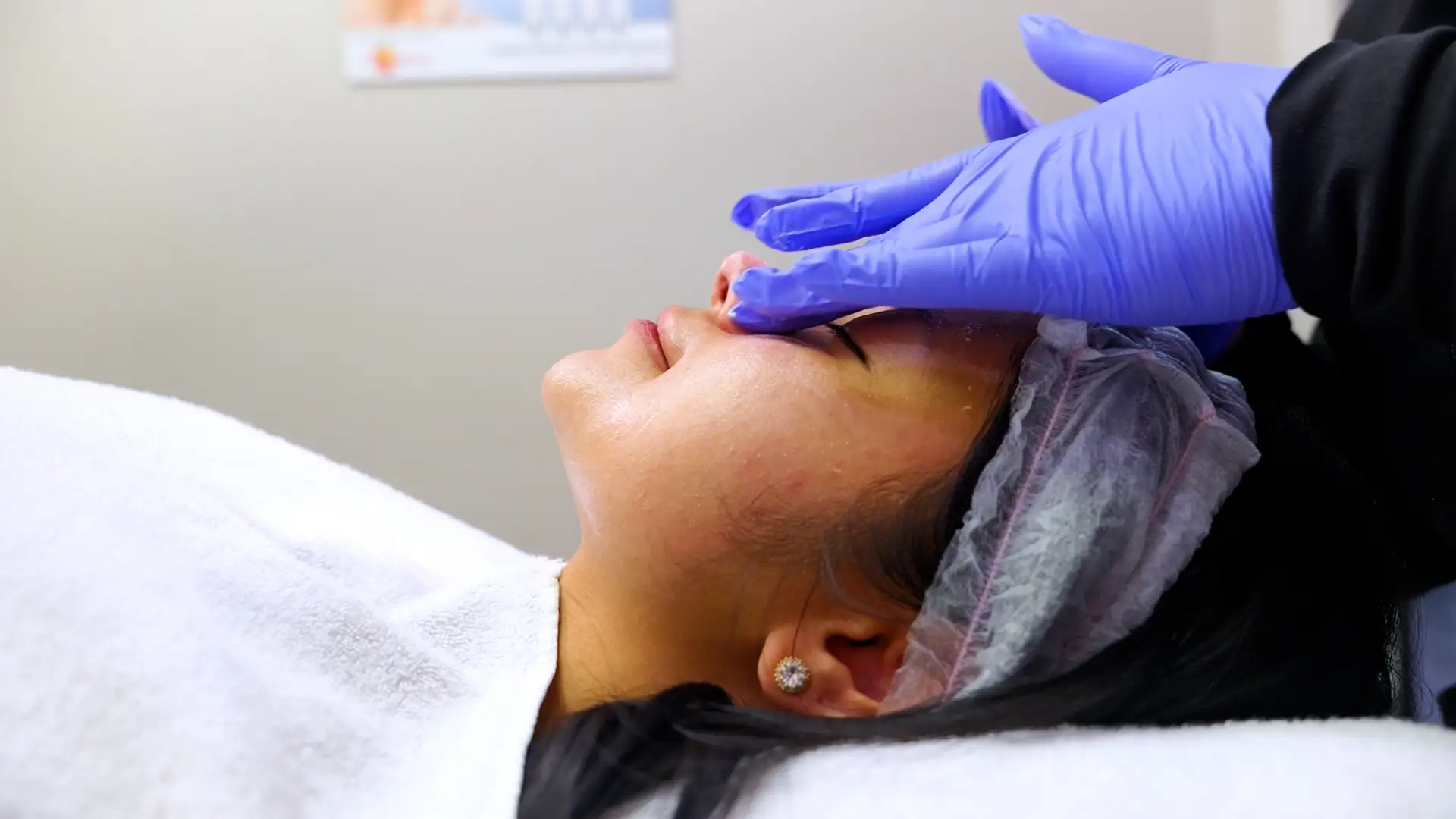 Tropicalaser Acne Treatment 05