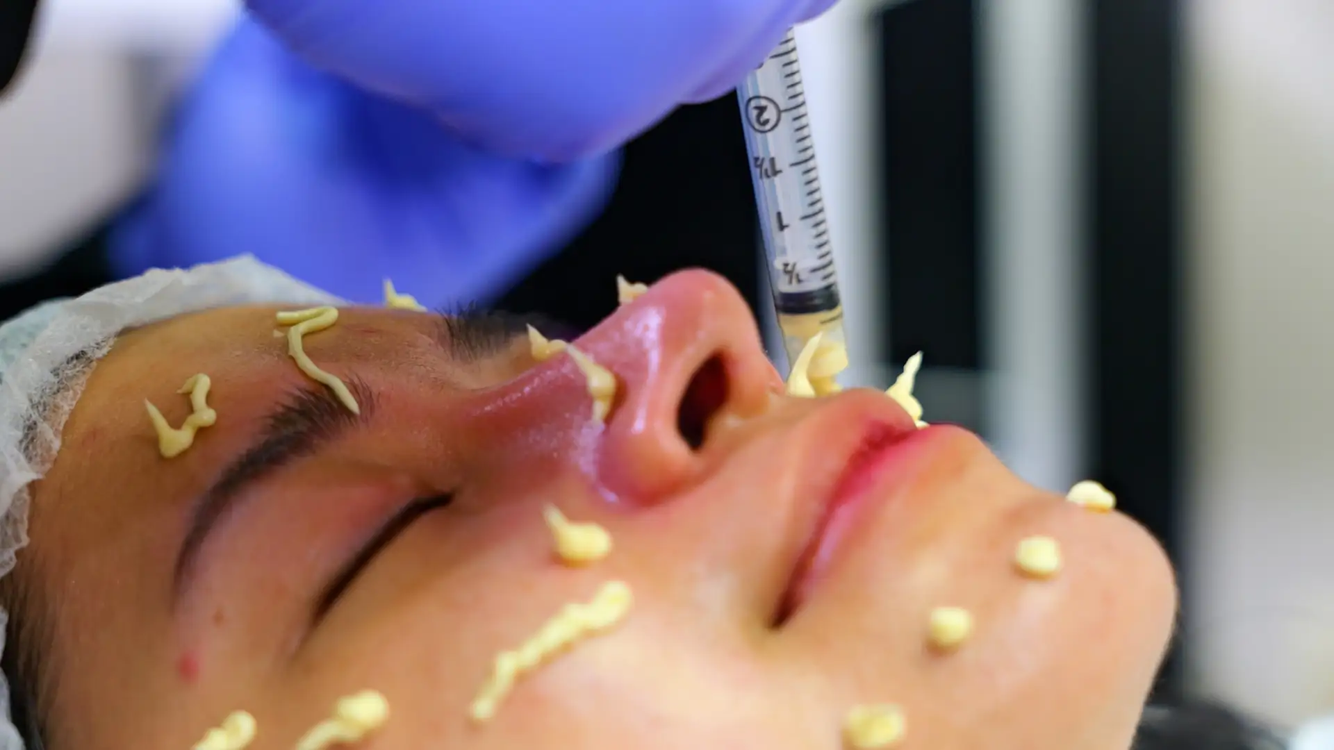 Tropicalaser Acne Treatment 06