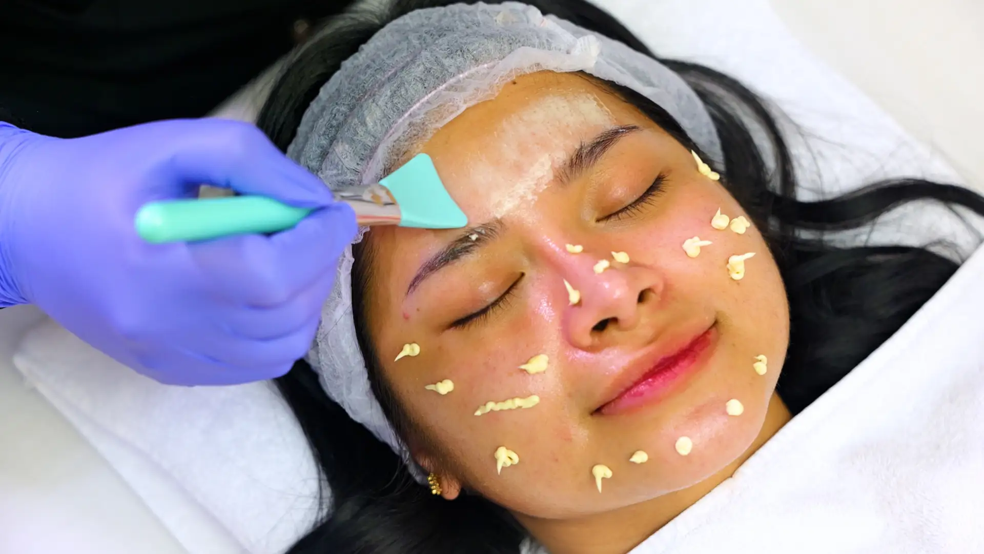 Tropicalaser Acne Treatment 07