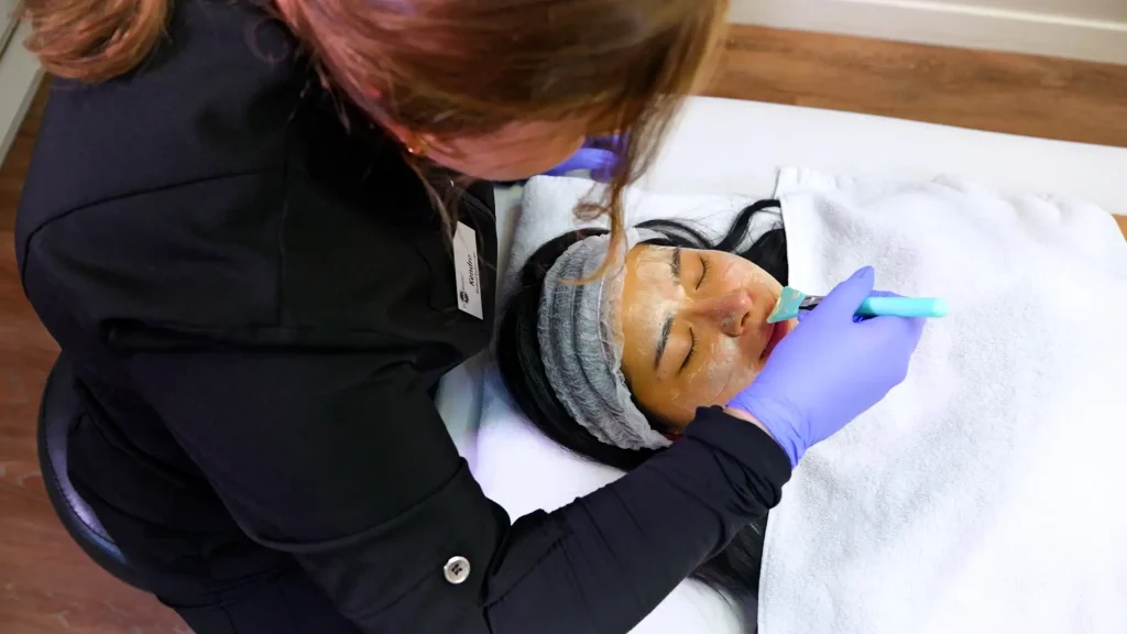 Tropicalaser Acne Treatment 08