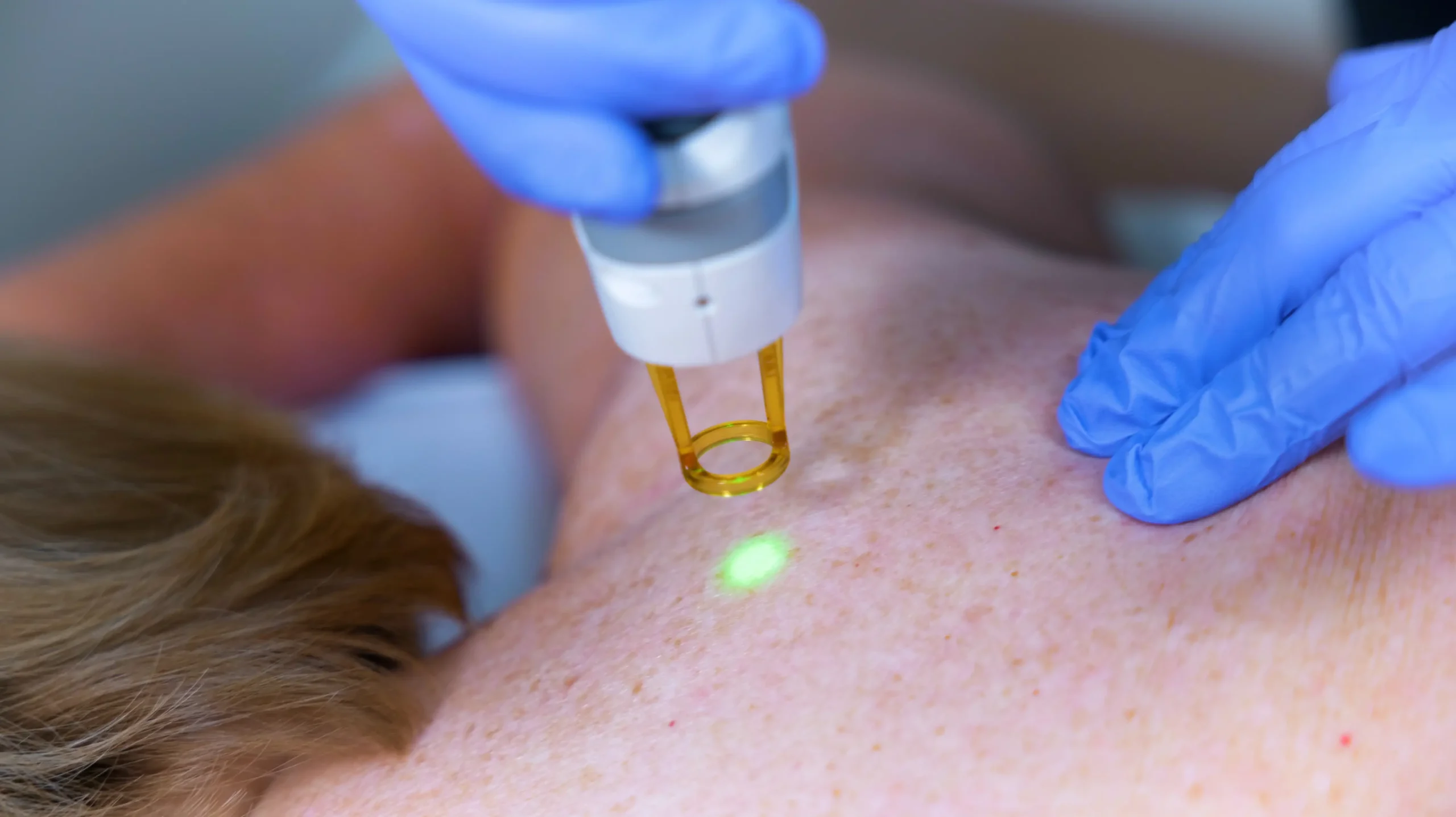 Tropicalaser Laser Hair Removal 03 scaled