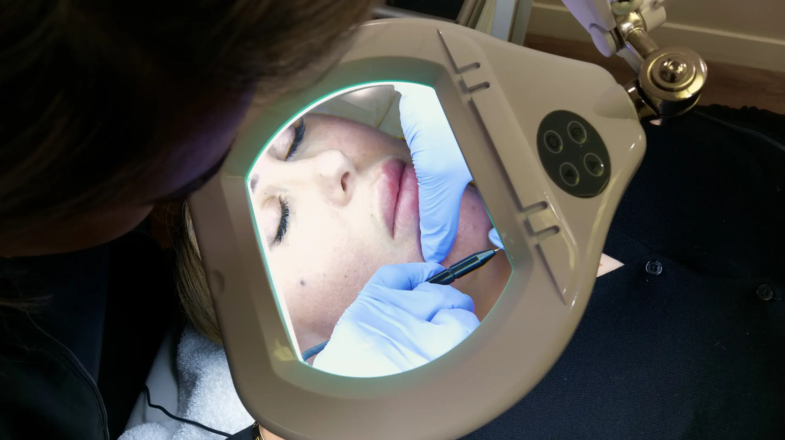 imgi 25 Tropicalaser Electrolysis Hair Removal 3 scaled 1