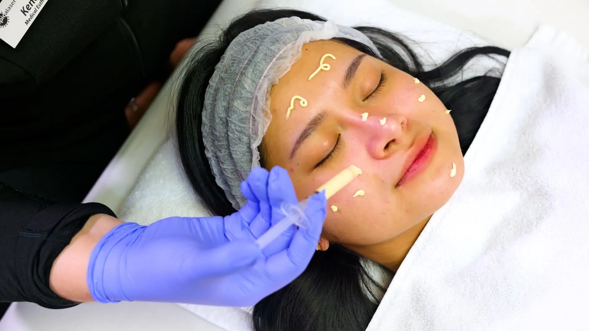 imgi 2 Chemical Peel Treatment Edmonton by Tropicalaser