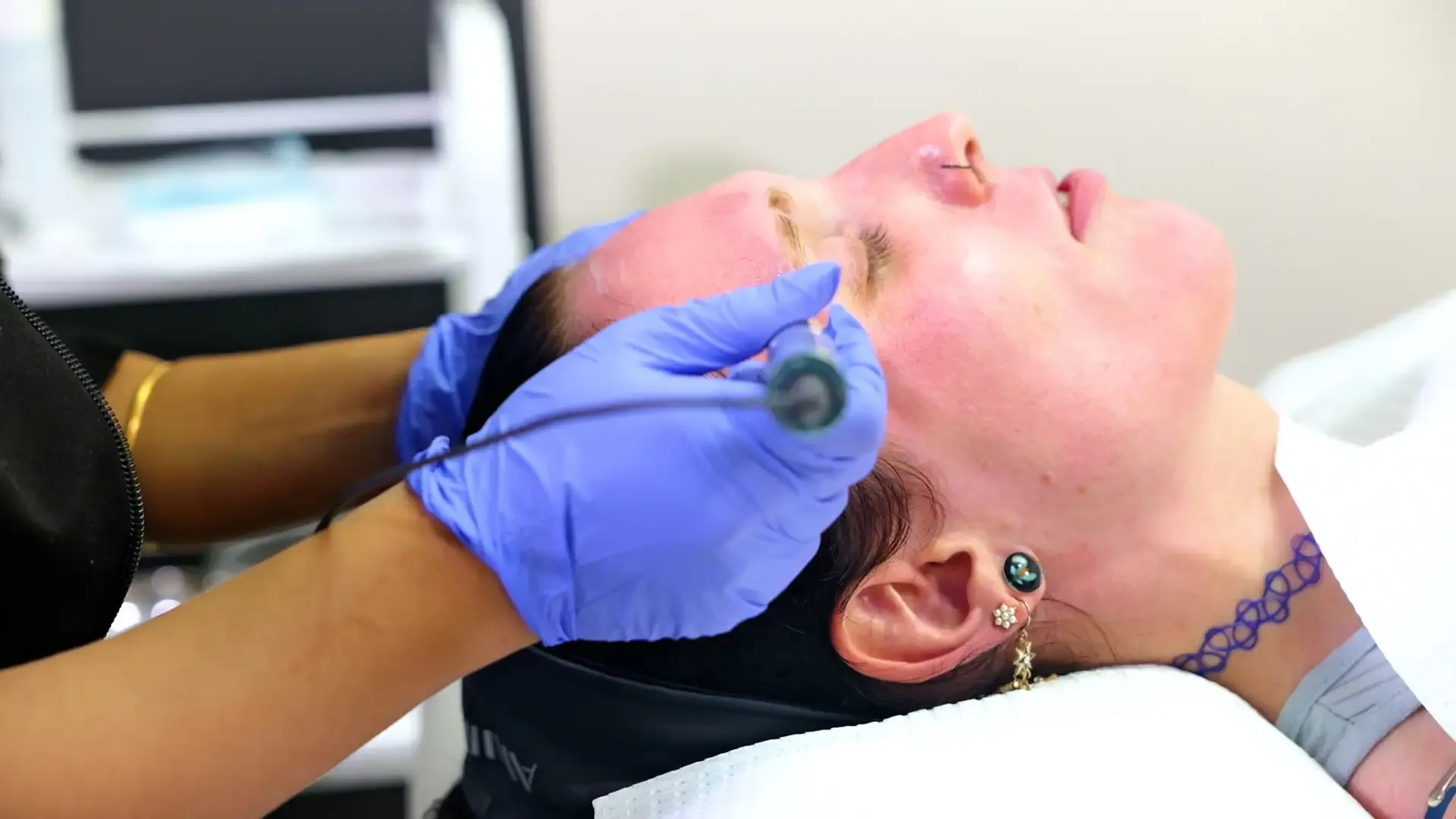 imgi 34 Tropicalaser Microneedling 4 Copy