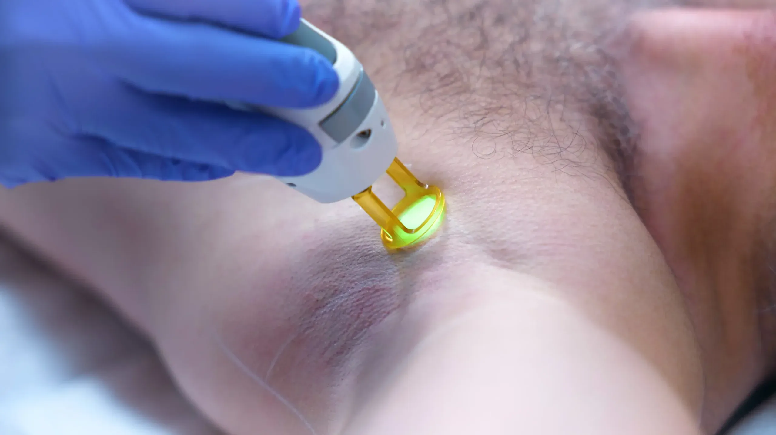 imgi 39 Tropicalaser Laser Hair Removal 11 scaled 1