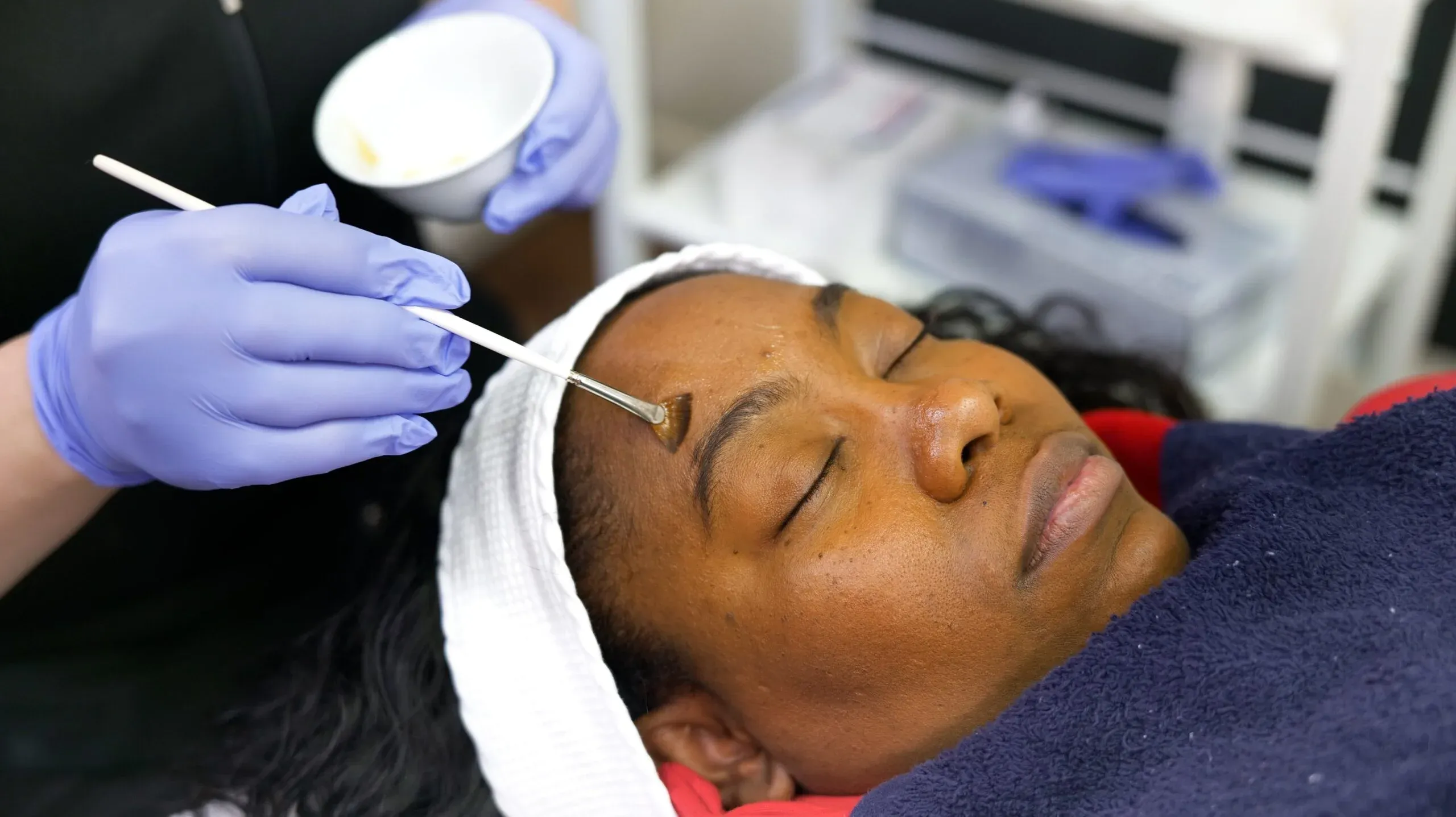 imgi 44 Chemcial Peel Edmonton min scaled 1