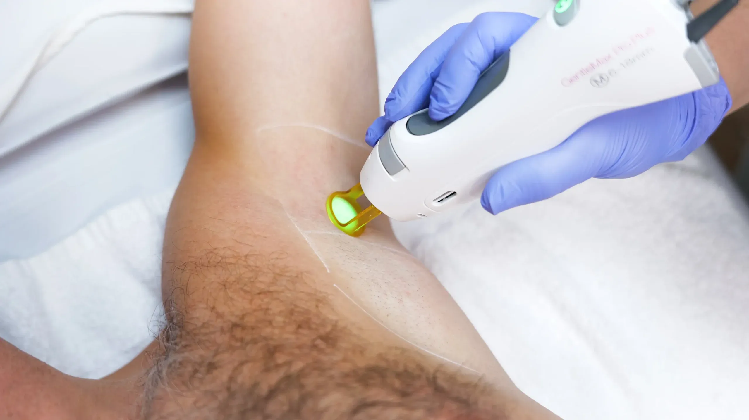 imgi 49 Tropicalaser Laser Hair Removal 08 scaled 1